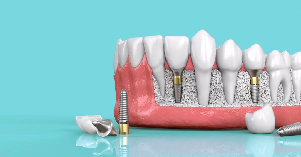 Tìm hiểu về công nghệ trồng răng Implant